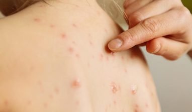 Sintomi varicella negli adulti e nei bambini: come curarla